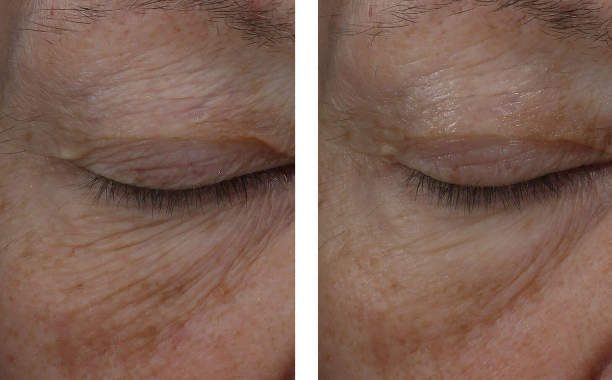 Interfuse InterFuse Treatment Cream EYE – Renuva Medspa