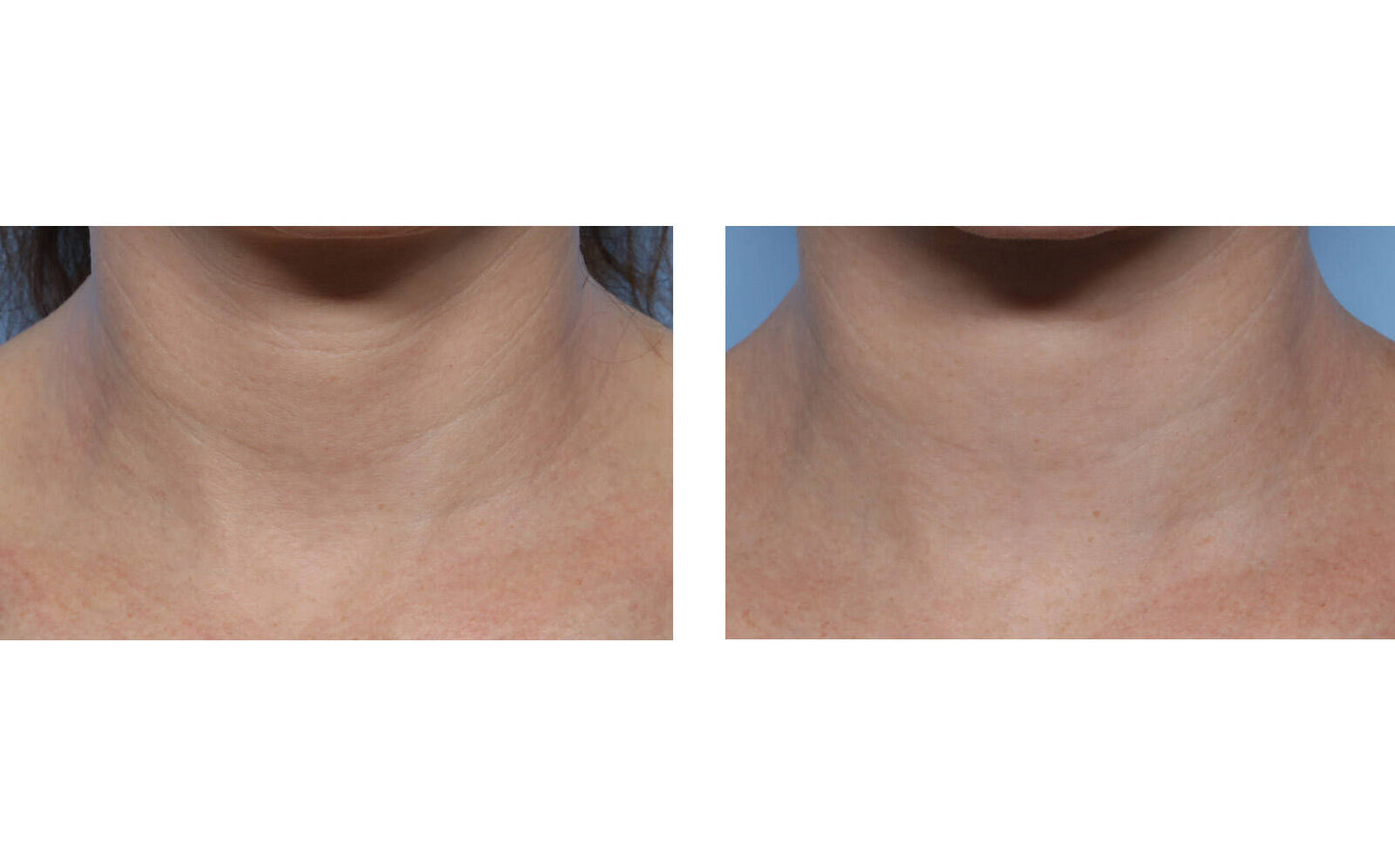 Techno Neck Perfecting Cream