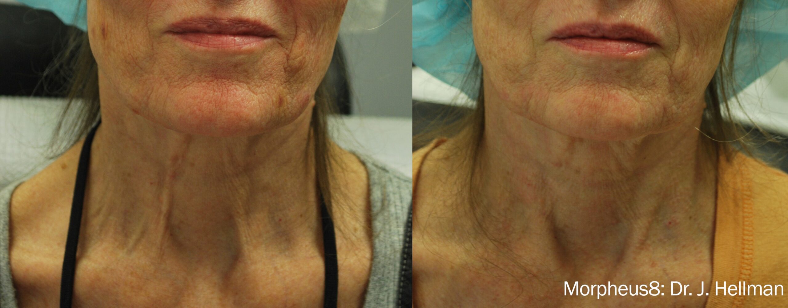 Lower Face Treatment