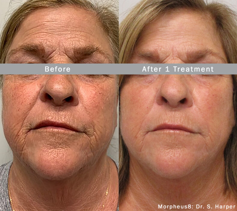 Face, Perioral & Neck Treatment